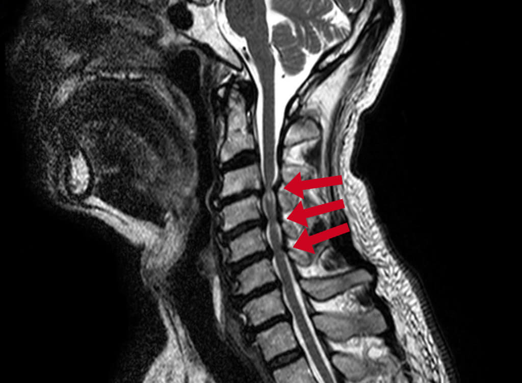 Diagnose van een kanaalvernauwing in de nek