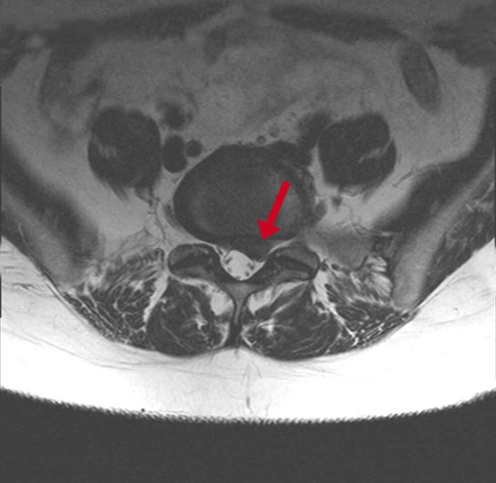 MRI van de wervelkolom