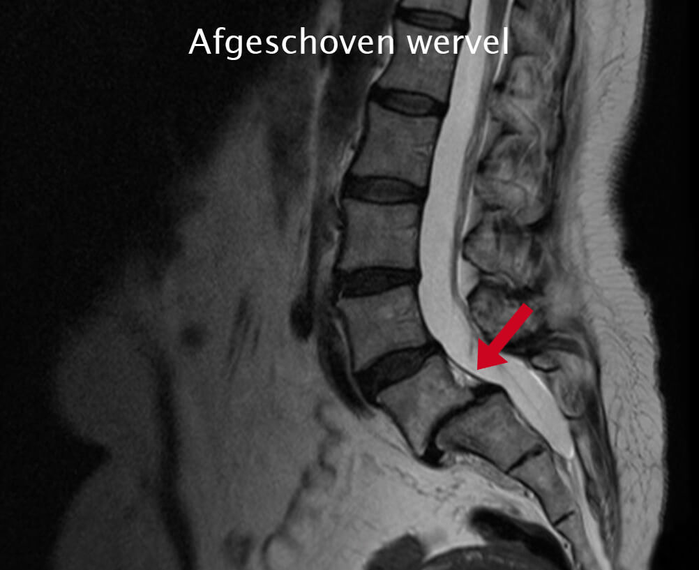 Diagnose van een instabiele wervelkolom