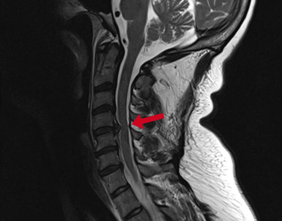 Diagnose van een nekhernia