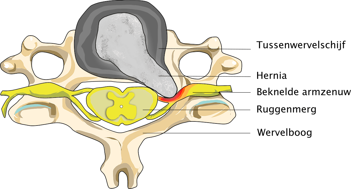 Nekhernia