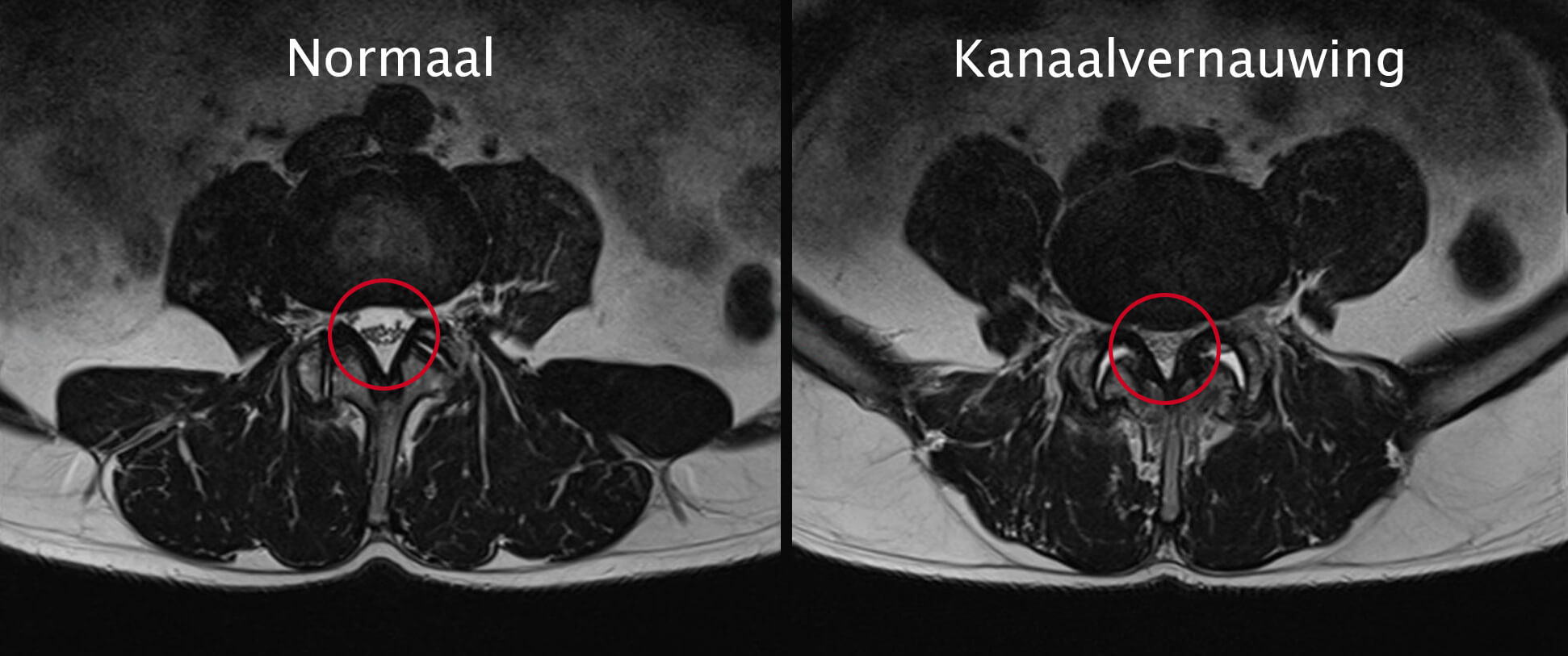 Diagnose van een kanaalvernauwing in de onderrug